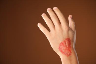 Photo of Man with burned hand on brown background, closeup. Space for text