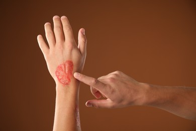 Photo of Man with burned hand on brown background, closeup. Space for text
