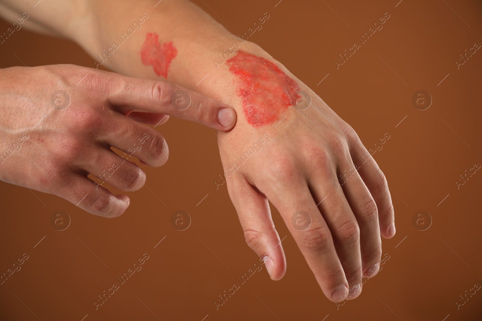 Man with burned hand on brown background, closeup Photo of Man with burned hand on brown background, closeup