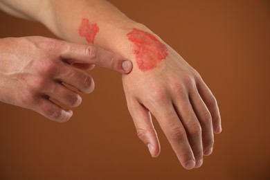 Photo of Man with burned hand on brown background, closeup
