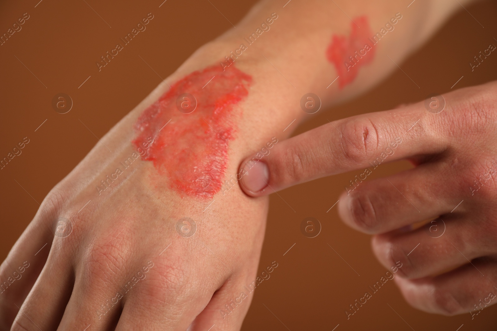 Man with burned hand on brown background, closeup Photo of Man with burned hand on brown background, closeup