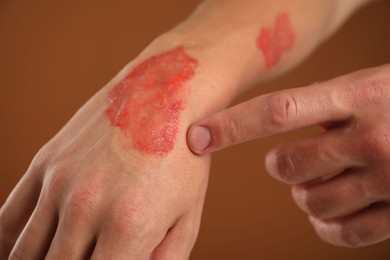 Photo of Man with burned hand on brown background, closeup