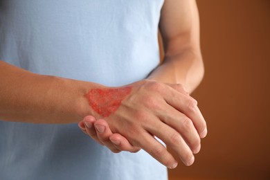 Photo of Man with burned hand on brown background, closeup