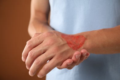 Photo of Man with burned hand on brown background, closeup