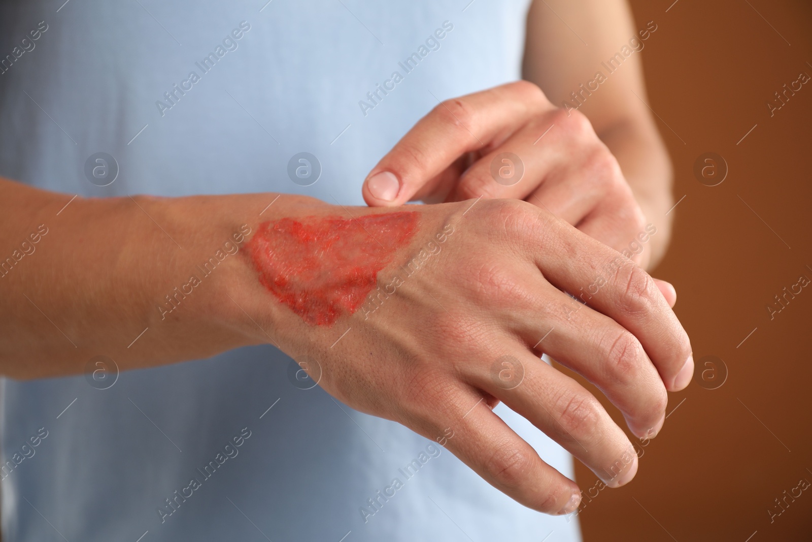 Man with burned hand on brown background, closeup Photo of Man with burned hand on brown background, closeup