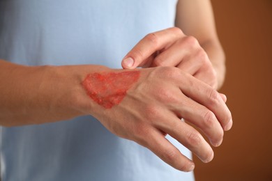 Photo of Man with burned hand on brown background, closeup