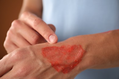 Photo of Man with burned hand on brown background, closeup