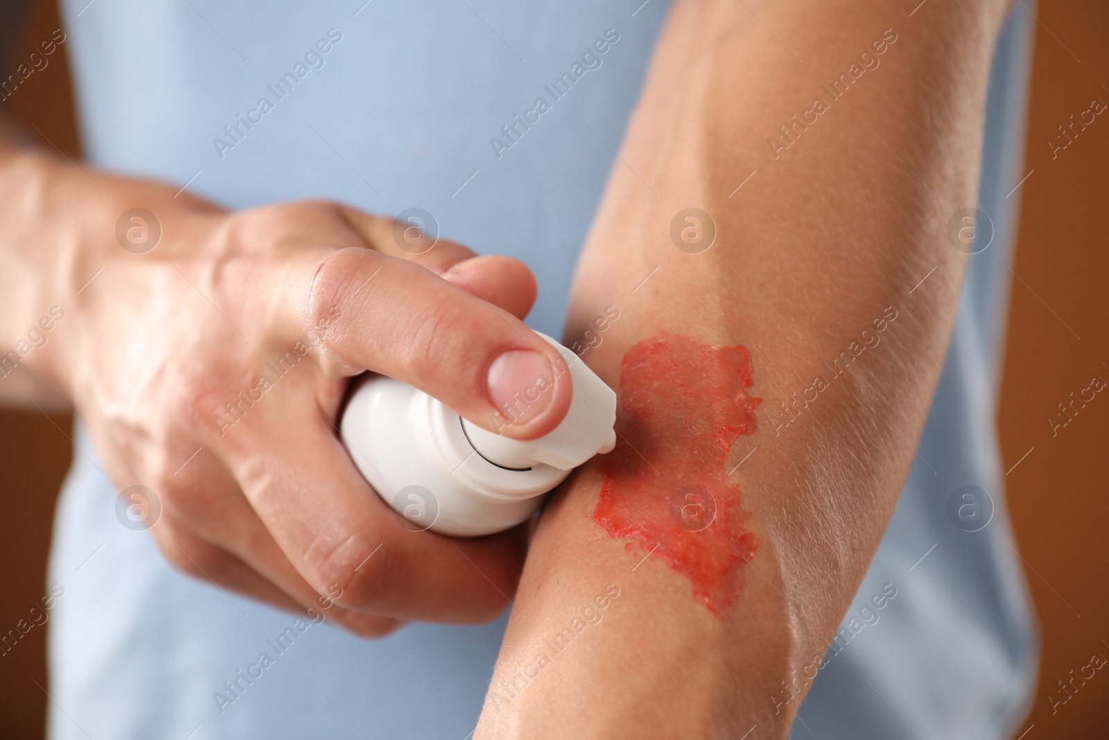 Man applying healing cream onto burned hand on brown background, closeup Photo of Man applying healing cream onto burned hand on brown background, closeup