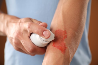 Photo of Man applying healing cream onto burned hand on brown background, closeup