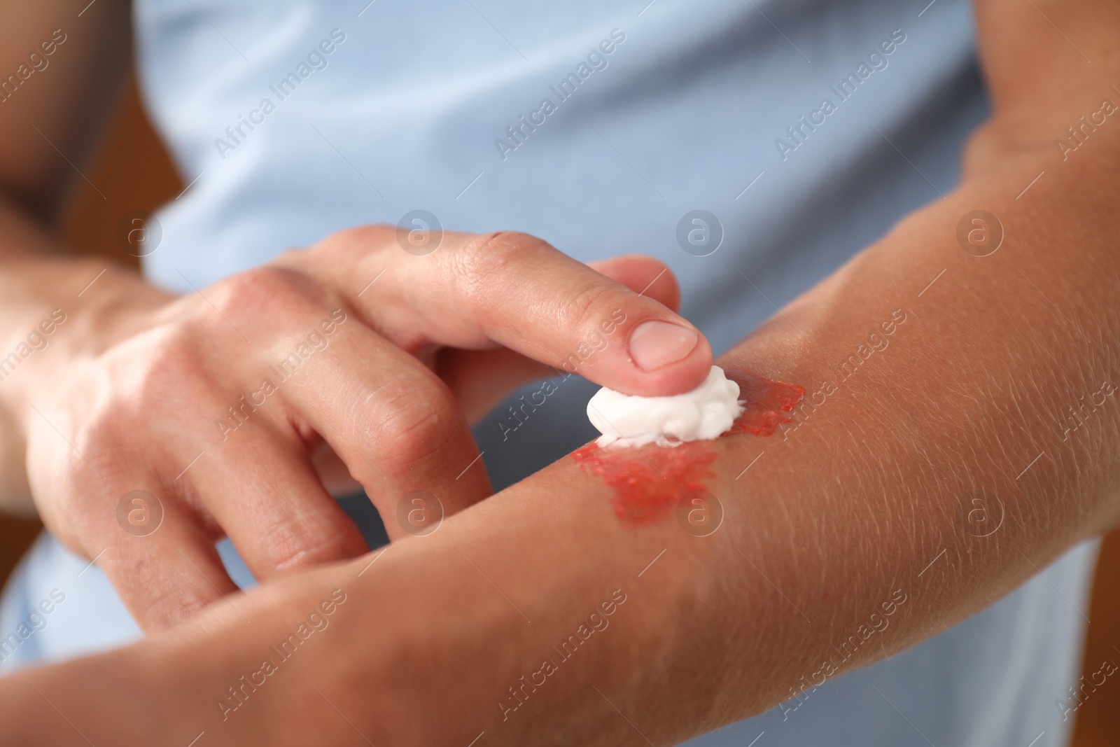 Man applying healing cream onto burned hand on brown background, closeup Photo of Man applying healing cream onto burned hand on brown background, closeup
