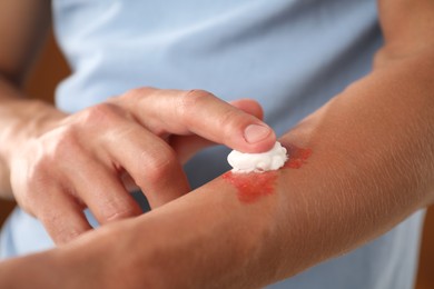 Photo of Man applying healing cream onto burned hand on brown background, closeup