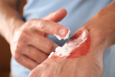 Photo of Man applying healing cream onto burned hand on brown background, closeup