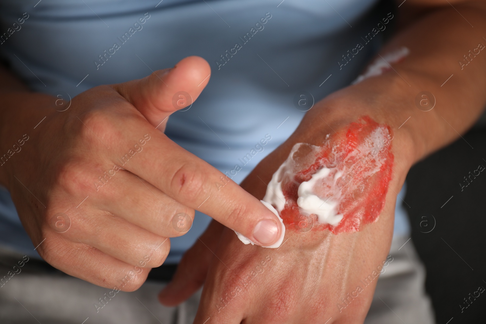 Man applying healing cream onto burned hand at home, closeup Photo of Man applying healing cream onto burned hand at home, closeup