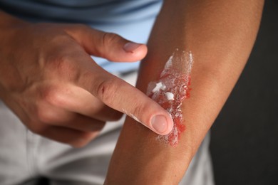 Photo of Man applying healing cream onto burned hand at home, closeup