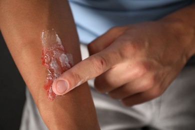Photo of Man applying healing cream onto burned hand at home, closeup