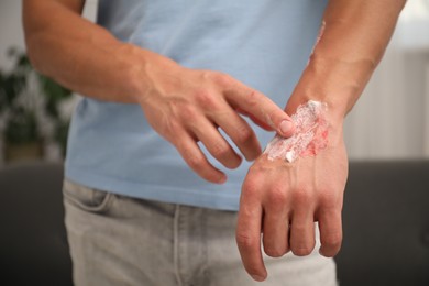 Photo of Man applying healing cream onto burned hand at home, closeup