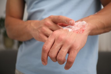 Photo of Man applying healing cream onto burned hand at home, closeup