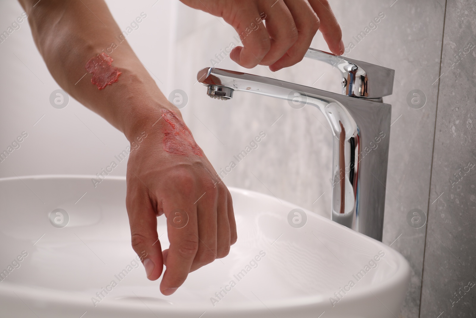 Photo of Man holding burned hand under water indoors, closeup