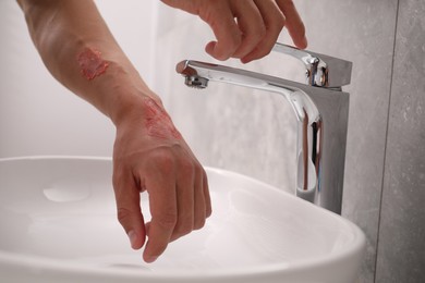 Photo of Man holding burned hand under water indoors, closeup