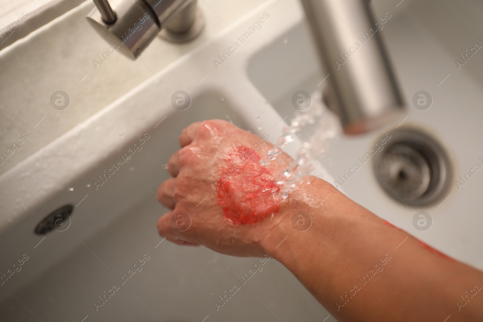 Photo of Man holding burned hand under water indoors, above view
