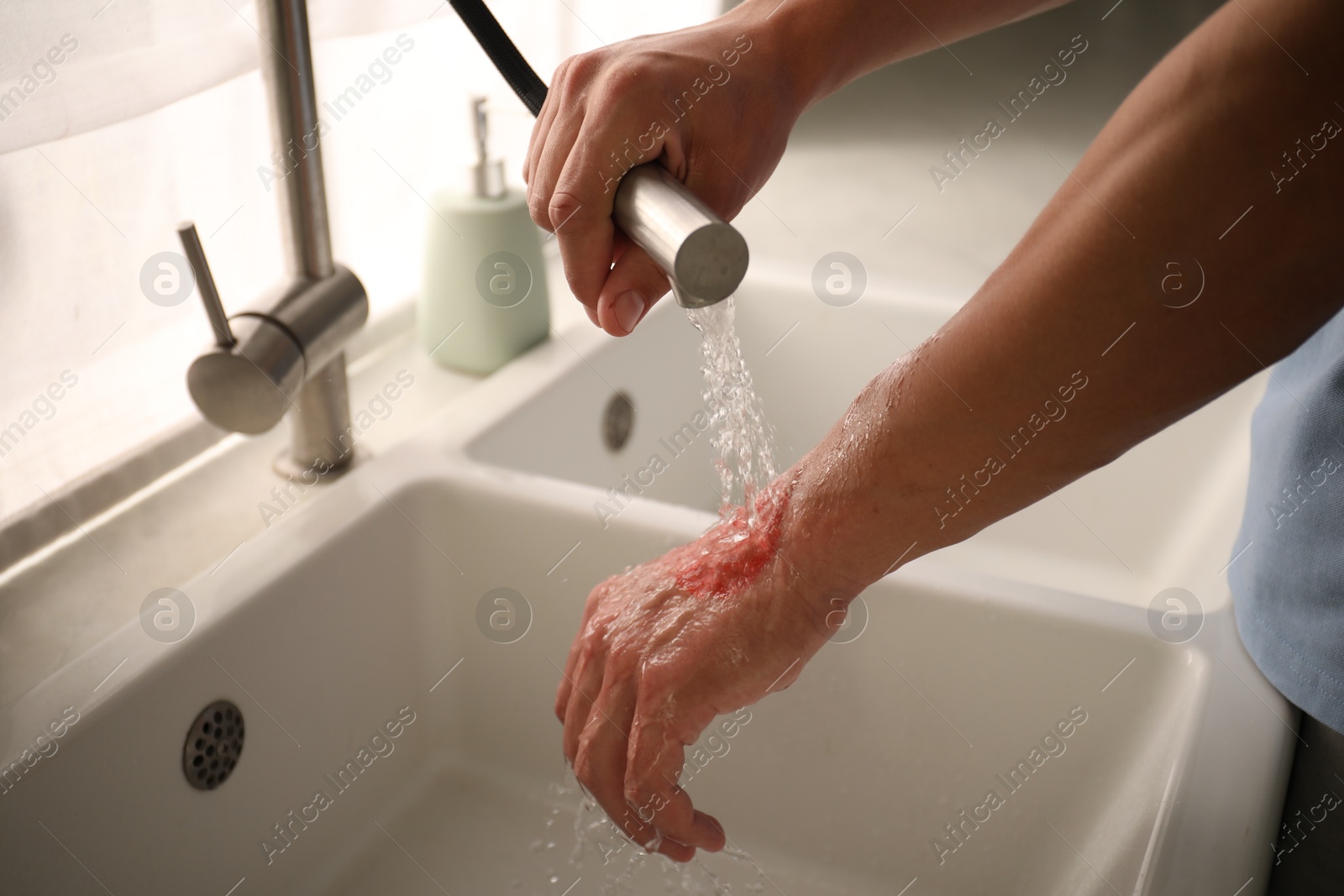 Photo of Man holding burned hand under water indoors, closeup