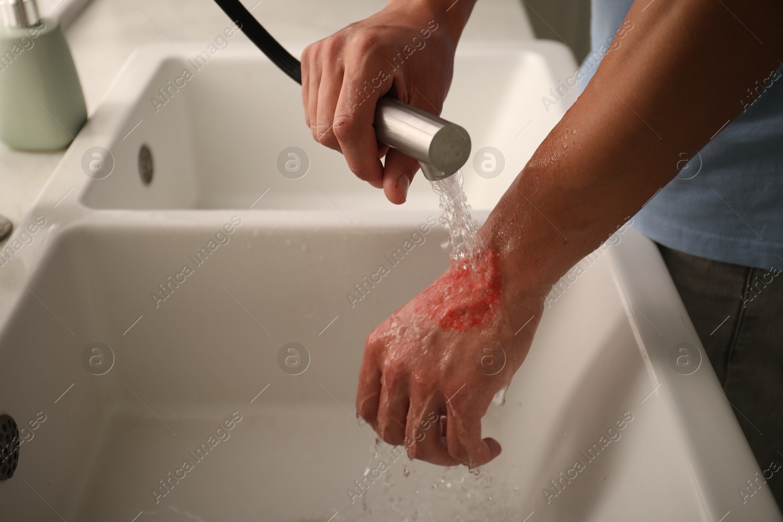 Photo of Man holding burned hand under water indoors, closeup