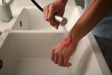 Photo of Man holding burned hand under water indoors, closeup