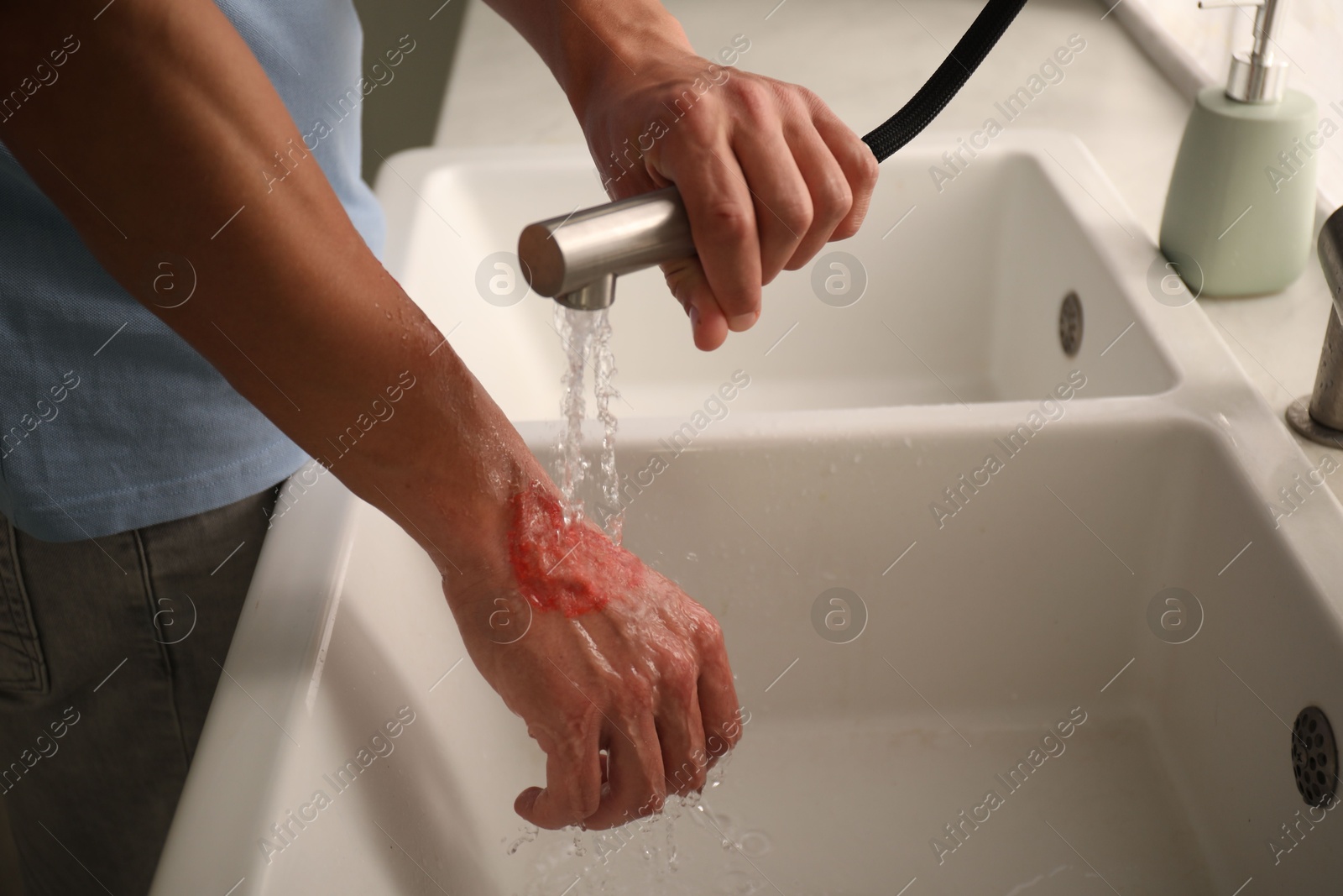 Photo of Man holding burned hand under water indoors, closeup