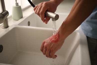 Photo of Man holding burned hand under water indoors, closeup