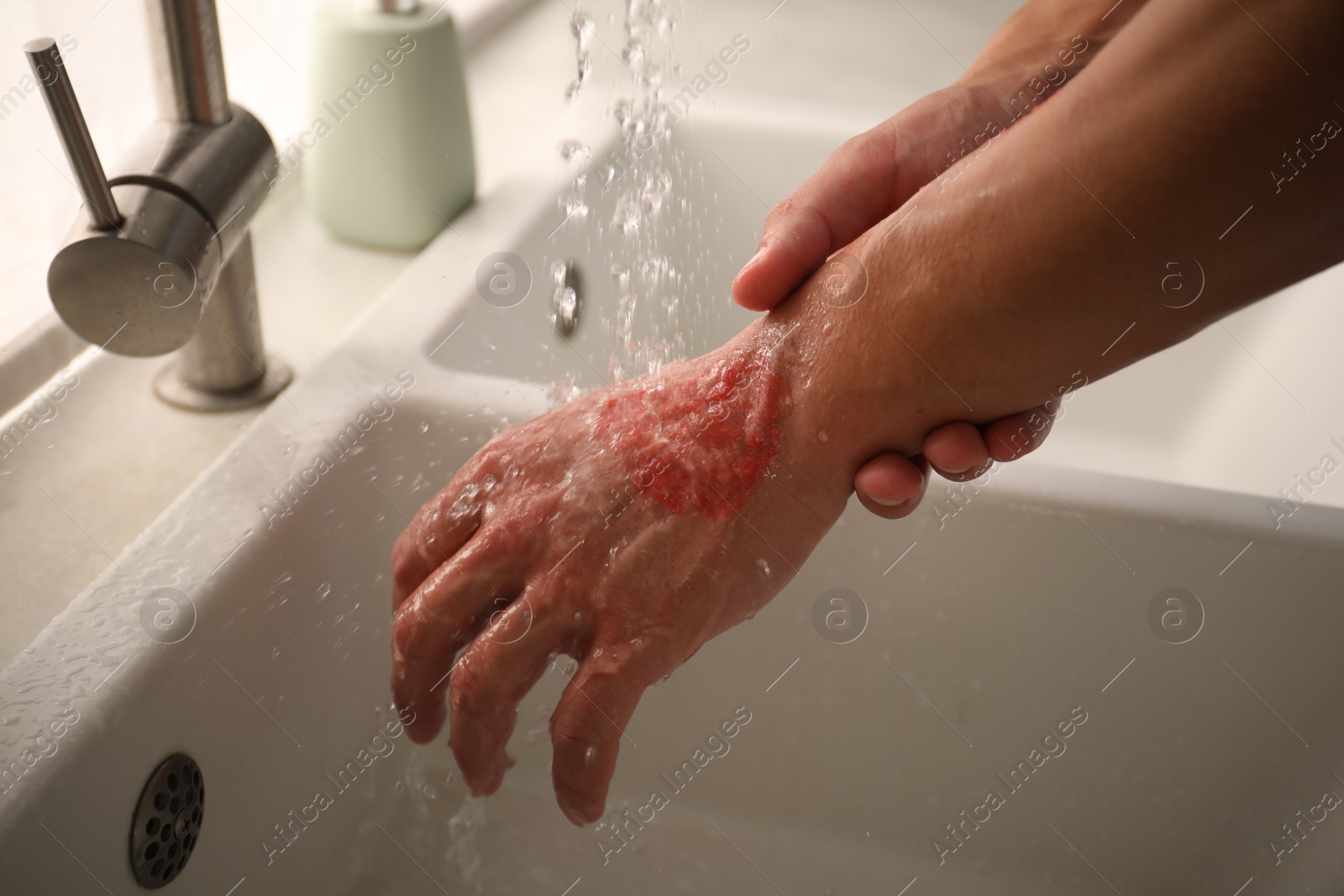 Photo of Man holding burned hand under water indoors, closeup