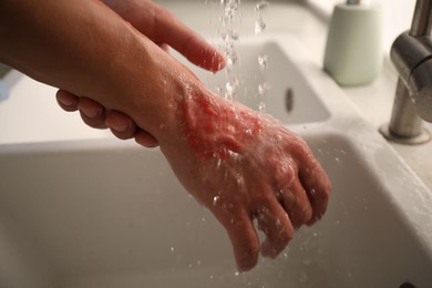 Photo of Man holding burned hand under water indoors, closeup