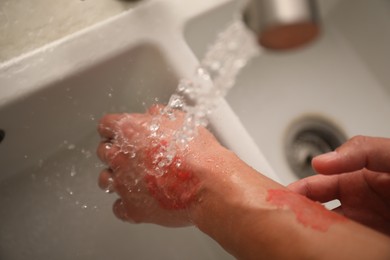 Photo of Man holding burned hand under water indoors, above view