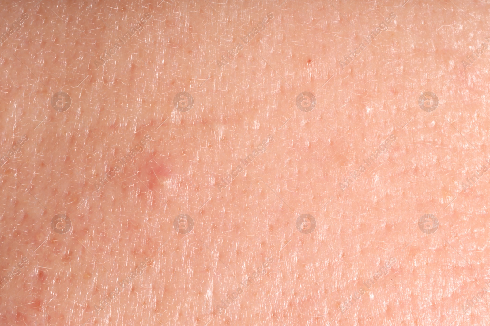 Human skin with acne problem, macro view. Detailed texture of surface Photo of Human skin with acne problem, macro view. Detailed texture of surface