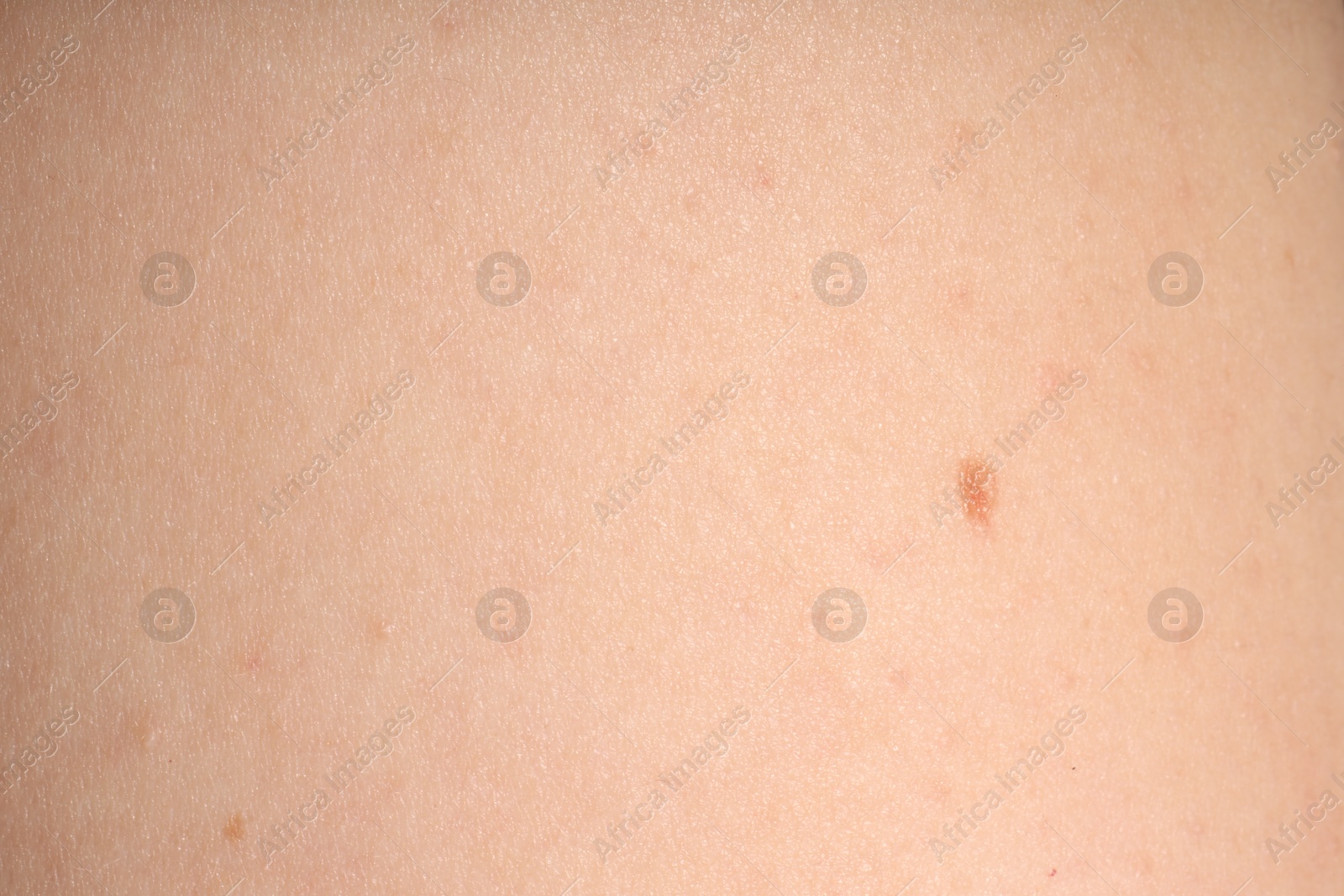 Macro view of skin with birthmarks as background Photo of Macro view of skin with birthmarks as background