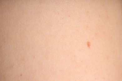 Photo of Macro view of skin with birthmarks as background