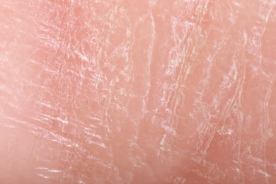 Photo of Macro view of dry human skin as background