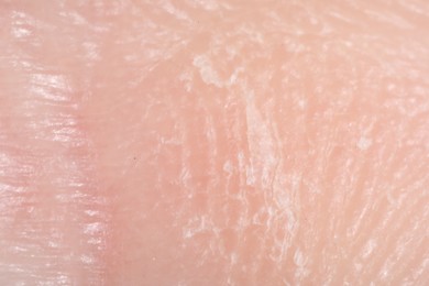 Photo of Macro view of dry human skin as background