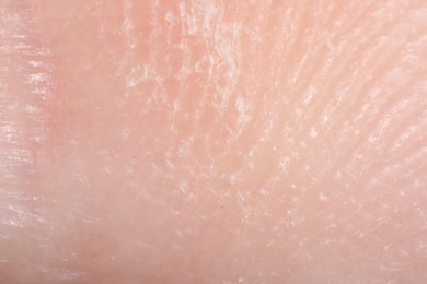 Photo of Macro view of dry human skin as background