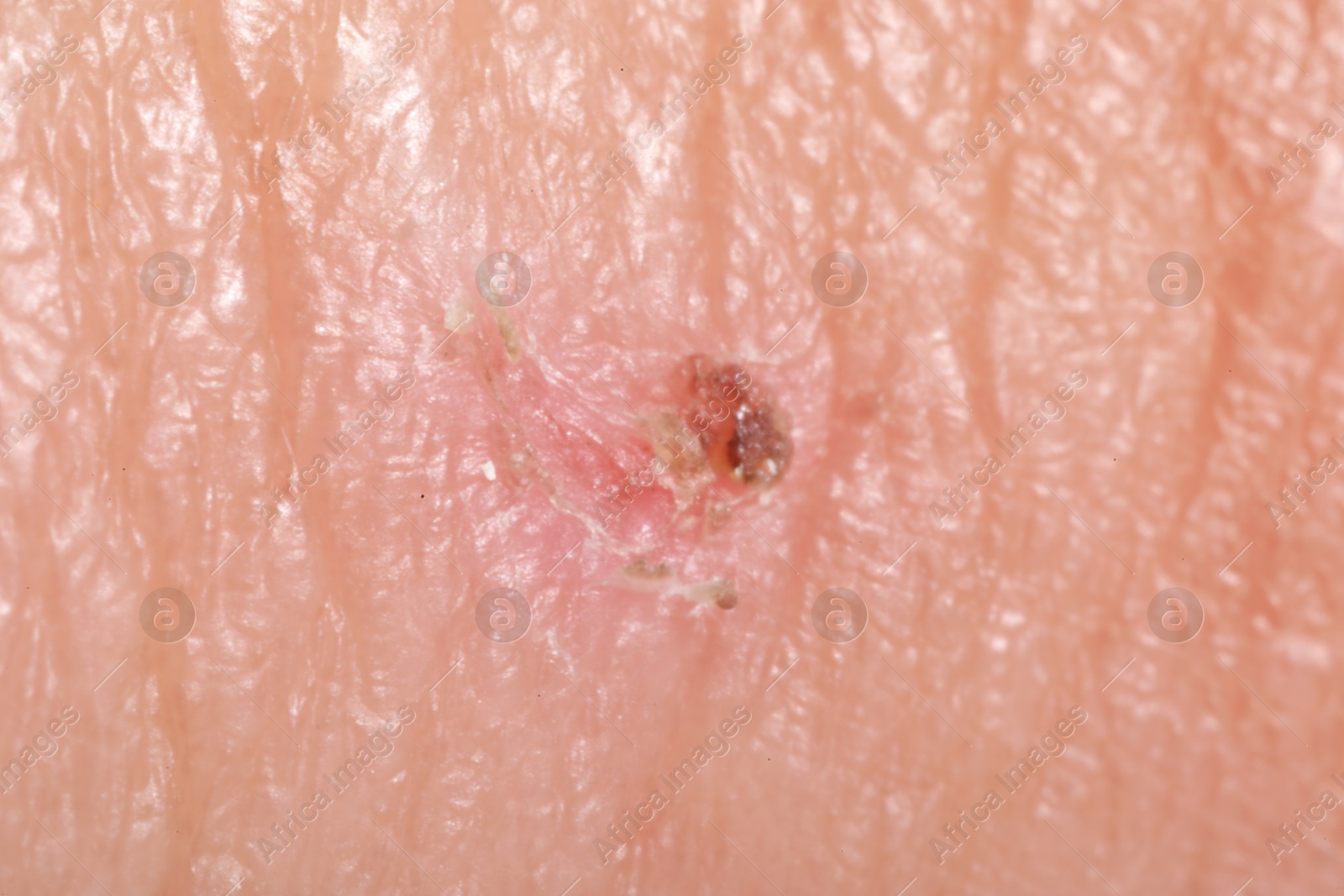 Macro view of damaged human skin as background Photo of Macro view of damaged human skin as background