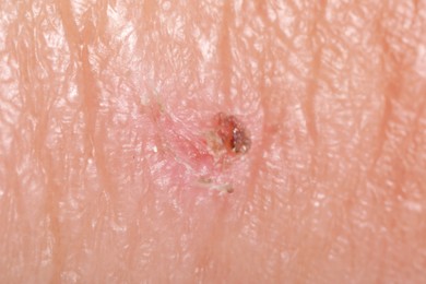 Photo of Macro view of damaged human skin as background