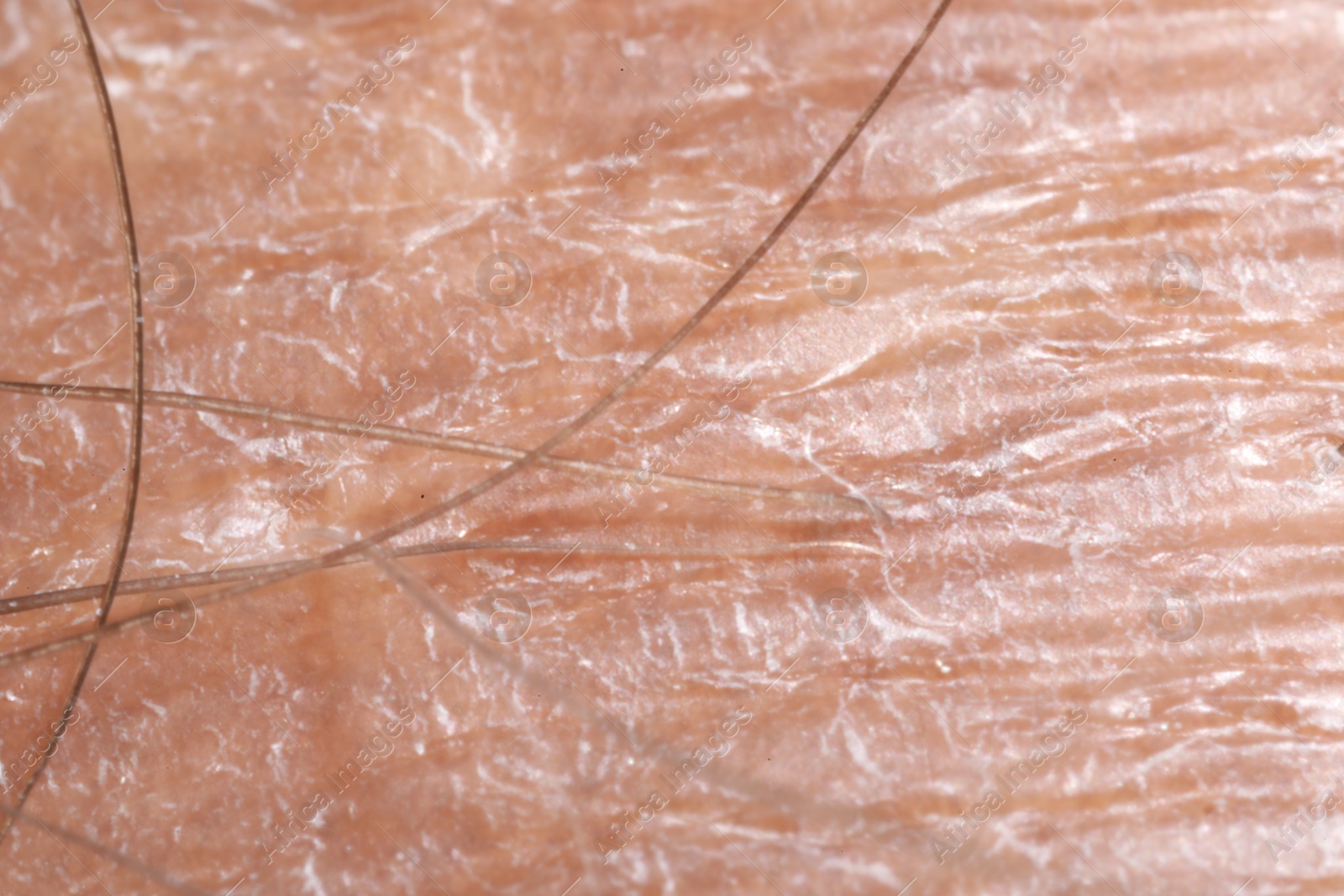 Macro view of dry human skin as background Photo of Macro view of dry human skin as background