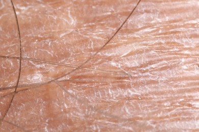 Photo of Macro view of dry human skin as background