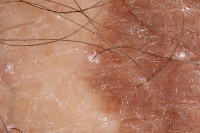 Photo of Macro view of skin with birthmark as background
