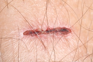 Photo of Macro view of damaged human skin as background