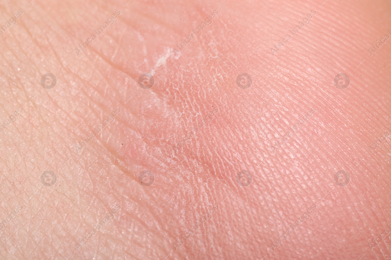 Macro view of dry human skin with wrinkles as background Photo of Macro view of dry human skin with wrinkles as background