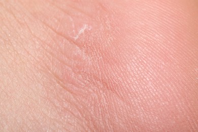 Photo of Macro view of dry human skin with wrinkles as background