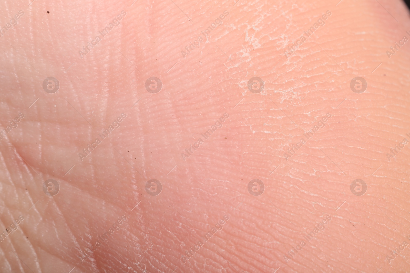 Macro view of dry human skin with wrinkles as background Photo of Macro view of dry human skin with wrinkles as background