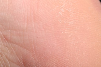 Photo of Macro view of dry human skin with wrinkles as background