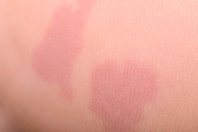 Photo of Macro view of dry human skin with red spots as background