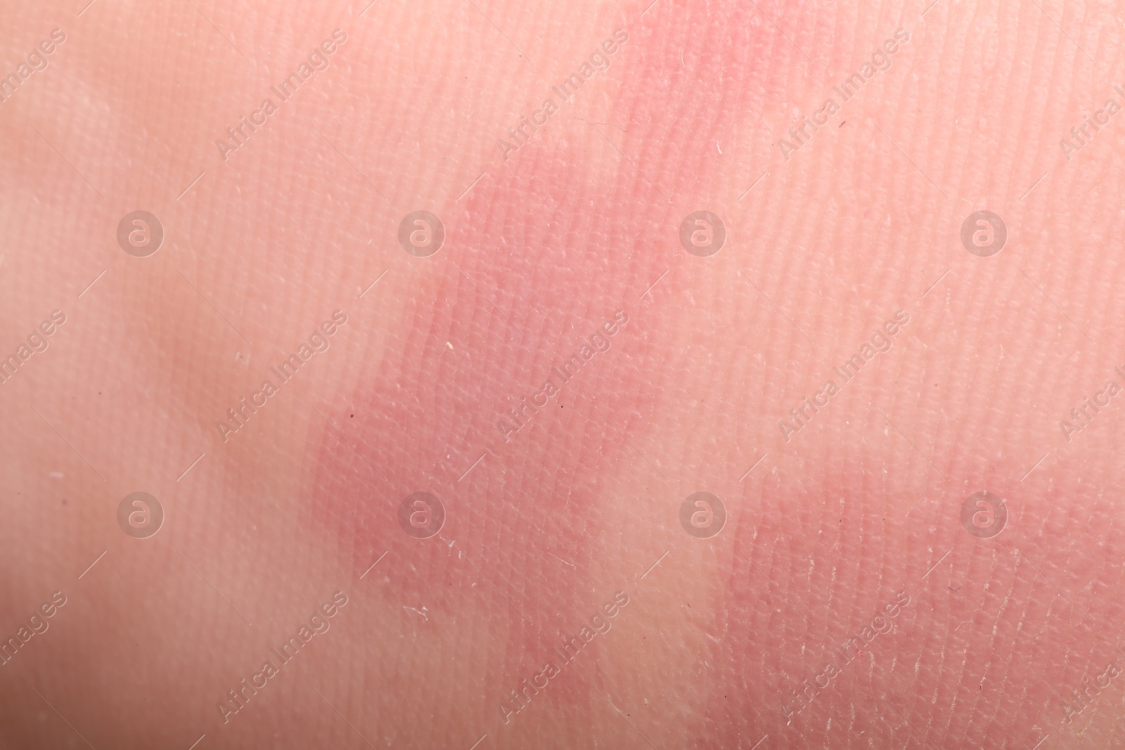 Macro view of dry human skin with red spots as background Photo of Macro view of dry human skin with red spots as background
